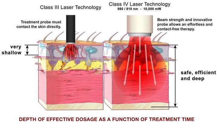 4th Class Laser Therapy
